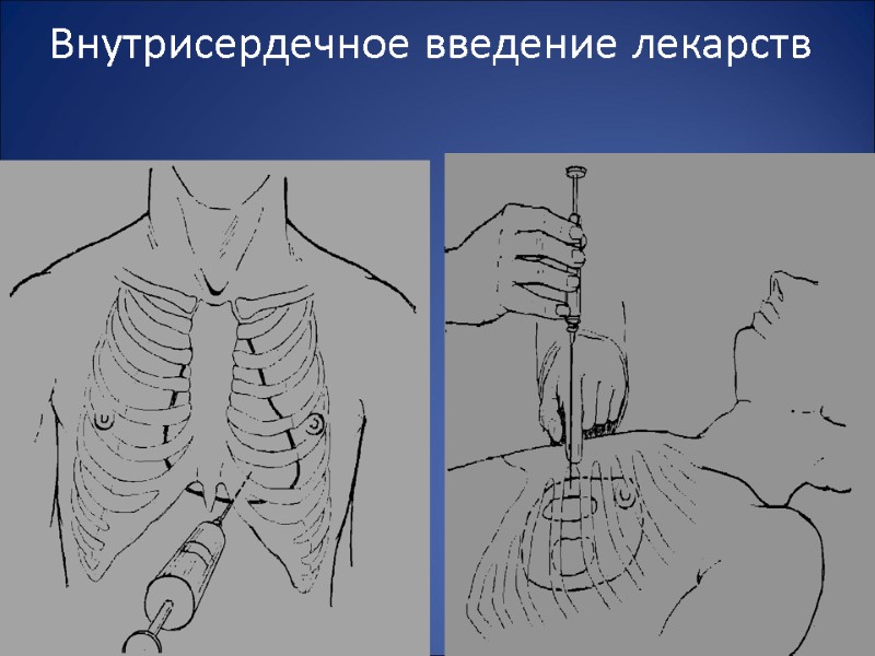 Внутрисердечное введение лекарств